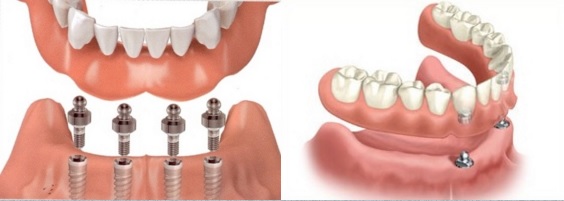 ايمپلنت براي دندان مصنوعي