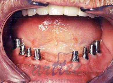 ايمپلنت دندان