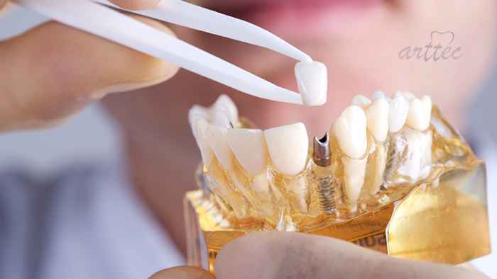 ثابت کردن پروتزهای متحرک با ایمپلنت دندان