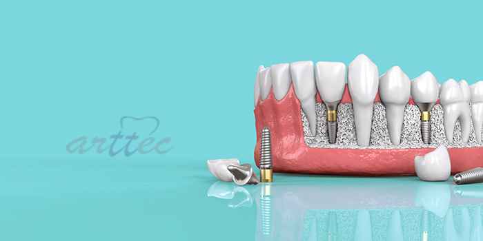 زمان بین کشیدن دندان و کاشت ایمپلنت دندان
