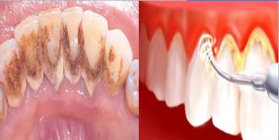 آیا جرمگیری دندان مضر است؟