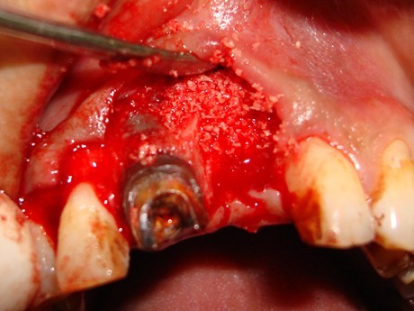 ايمپلنت دندان