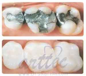 مواد ترمیمی در دندانپزشکی زیبایی
