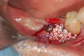 پیوند استخوان در درمان ایمپلنت دندان
