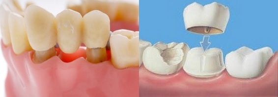 درمان عفونت دندان روکش شده