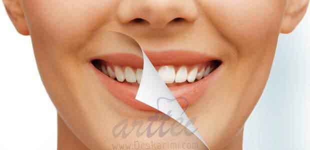 بستن فاصله بین دندانی