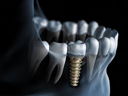 ایمپلنت دندان چقدر طول میکشه