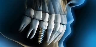 چند سال بعد از کشیدن دندان میتوان ایمپلنت کرد
