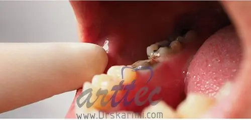 ترمیم روکش دندان در دندانپزشکی زیبایی