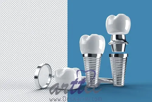 ایمپلنت دندان با پیوند استخوان