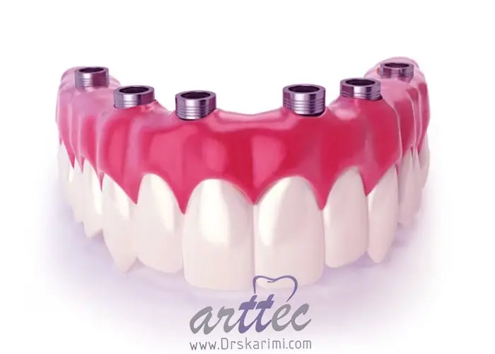 ایمپلنت برای دندان مصنوعی