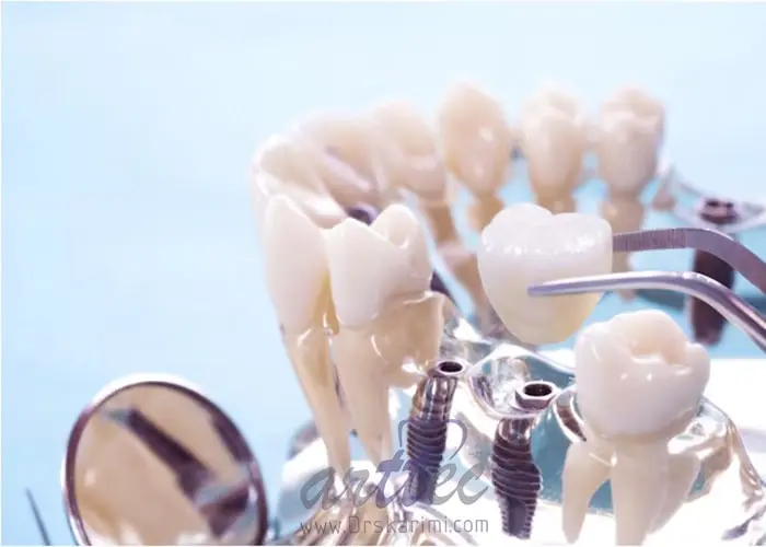  آیا کاشت ایمپلنت دندان برای بیماران قلبی امکان پذیر است؟