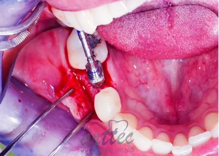 آیا کاشت ایمپلنت دندان برای بیماران قلبی امکان پذیر است؟