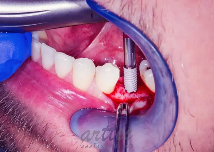مراقبت از ایمپلنت های دندانی