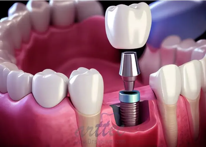 ایمپلنت دندان از چه اجزایی تشکیل شده اند؟