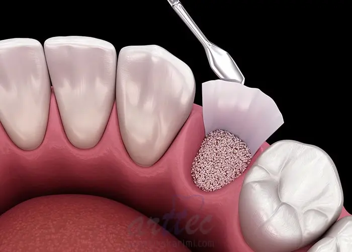 آیا با وجود پوکی استخوان می توان ایمپلنت کاشت؟