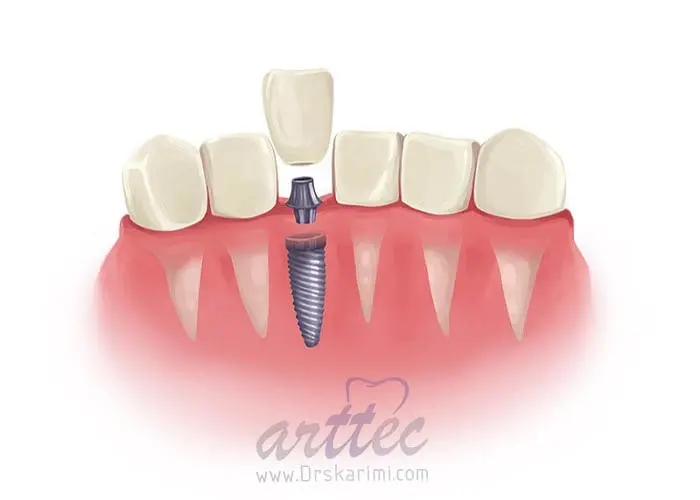 سخت ترین مرحله ایمپلنت دندان چیست؟