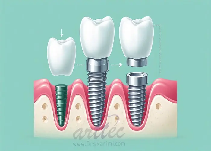 تحلیل استخوان فک بعد از ایمپلنت دندان چیست؟