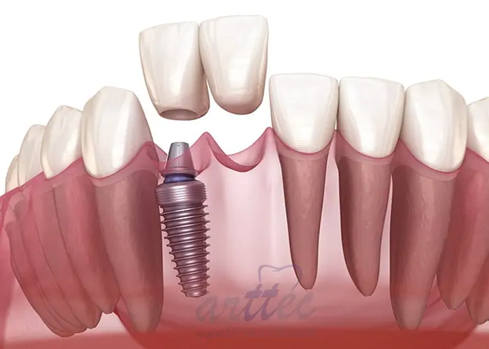 ایمپلنت بهتر است یا پروتز ثابت دندان؟