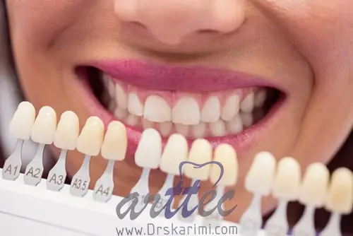 مراقبت از لمینت دندان - دکتر سعید کریمی