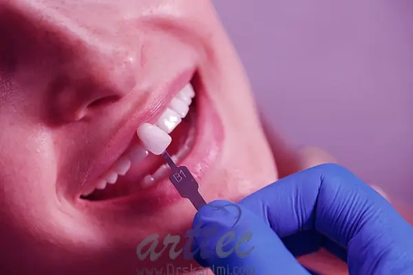 علت شکستن یا افتادن لمینت دندان چیست؟