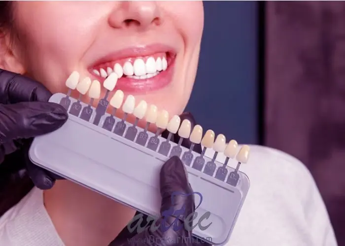 میزان تراشیدن دندان برای لمینت دندان چقدر است؟