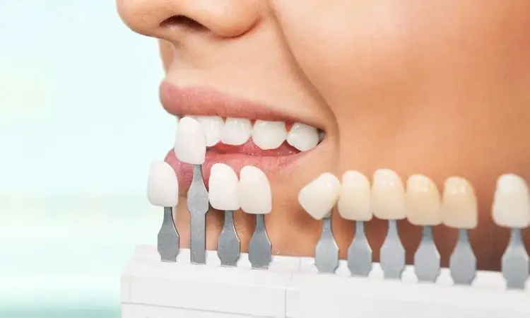 میزان تراشیدن دندان برای لمینت دندا