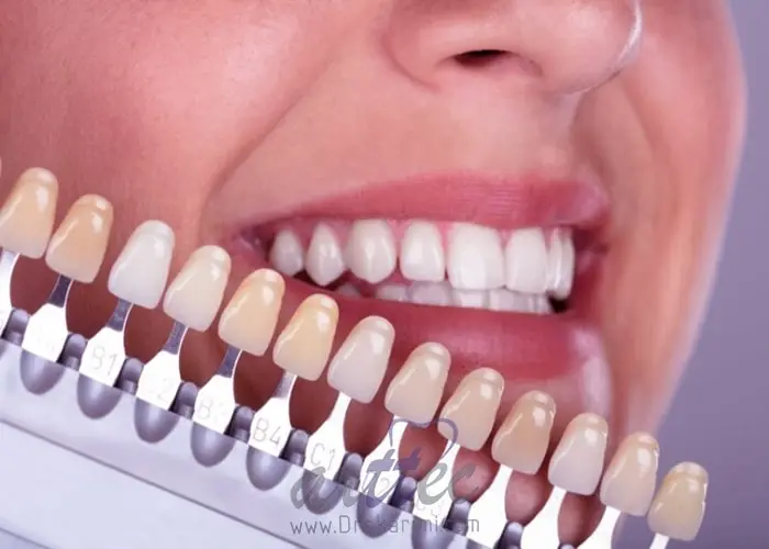 لمینت کریستالی دندان چیست؟