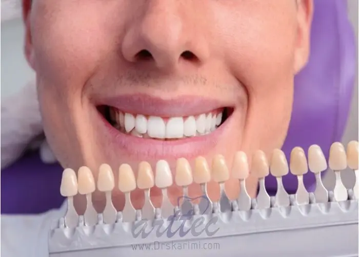آیا می توان لمینت دندان را دوباره سفید کرد؟