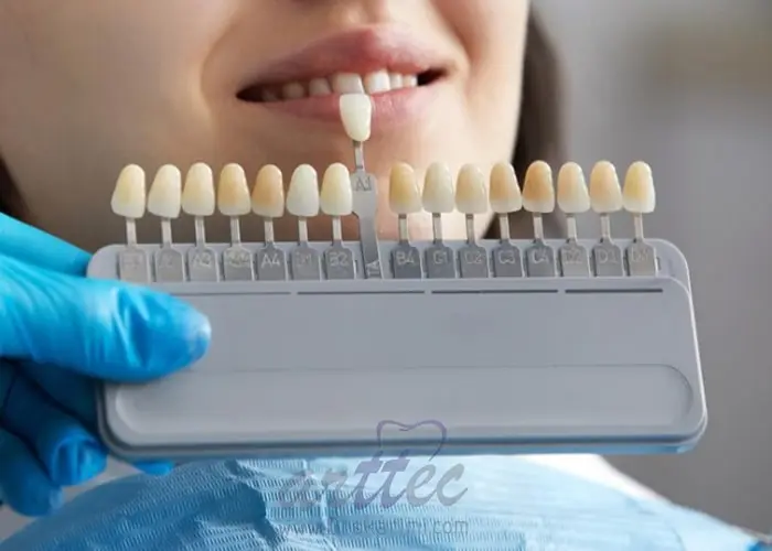  آیا می‌توان لمینت دندان را دوباره سفید کرد؟