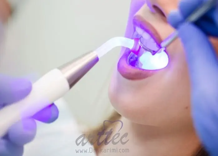 دندانپزشکی لیزری در تهران