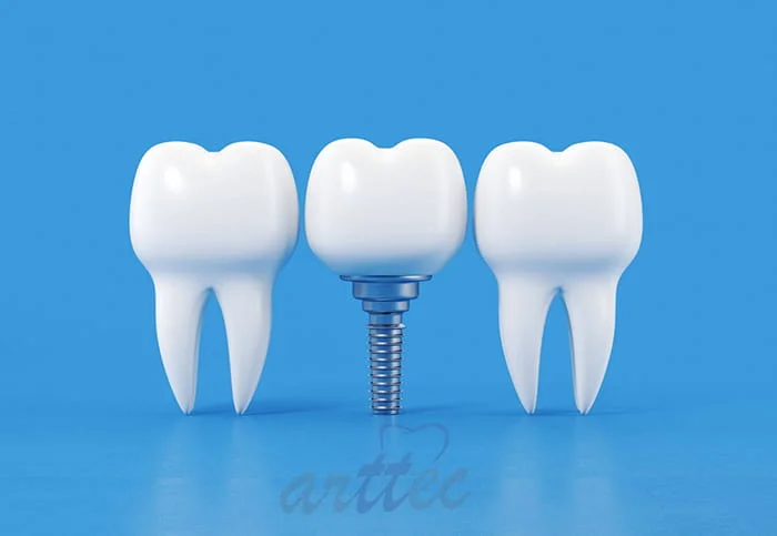 ایمپلنت پایه کوتاه چیست؟ مزایا، معایب و هزینه 