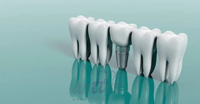 ایمپلنت پایه کوتاه چیست؟ مزایا، معایب و هزینه 