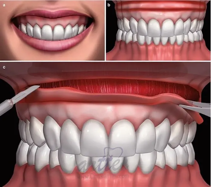 جراحی افزایش طول تاج دندان چیست؟