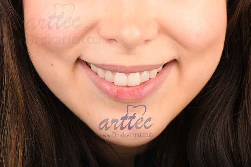 آنالیز لبخند توسط دندانپزشک زیبایی
