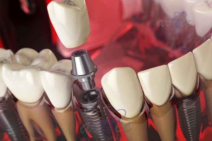 ایمپلنت دندان دندانهای جلو چگونه است