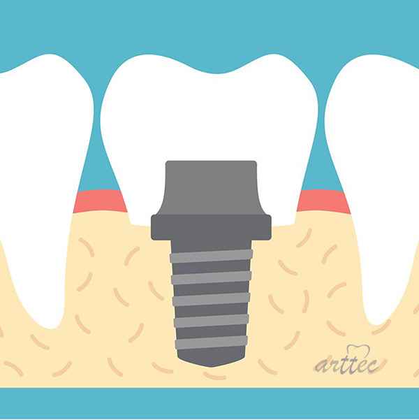 ثابت کردن پروتزهای متحرک با ایمپلنت دندان