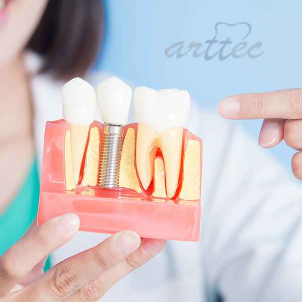 برای مراقبت ایمپلنت دندان رعایت بهداشت و مسواک زدن ضروری است