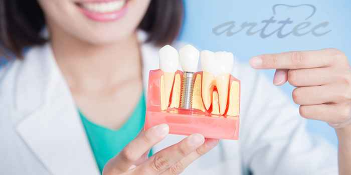 مراحل کاشت ایمپلنت دندان