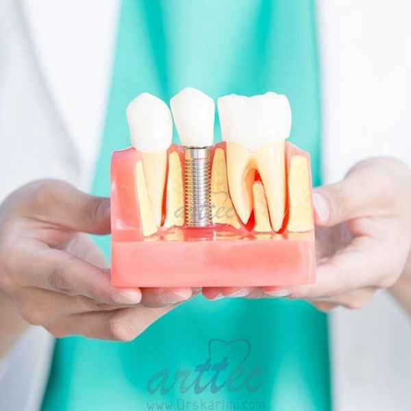شرایط برای کاشت ایمپلنت دندان چیست