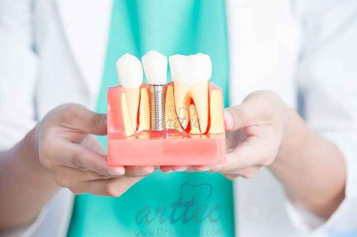 لق شدن ایمپلنت دندان