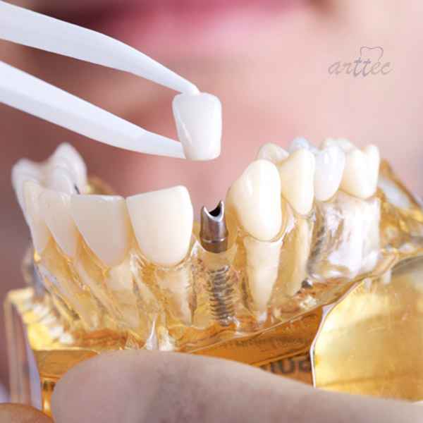 در مورد ایمپلنت دندان بدانید