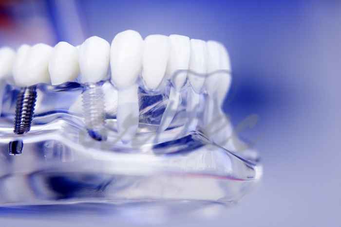 مراحل کاشت ایمپلنت دندانی