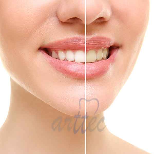 هزینه بلیچینگ دندان و مراقبت های پس از بلیچینگ