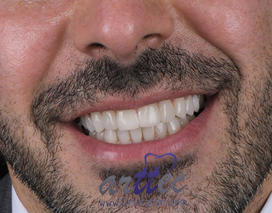 بازسازي لبخند طبيعي با لمينت هاي سراميكي فوق و العاده نازک و بدون تراش دندان یا حداقل تراش