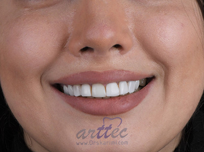 بازسازی لبخند با لمینت های سرامیکی - 10 واحد لمینت سرامیکی با حداقل تراش و حداقل ضخامت برای دندان های قدامی فک بالا