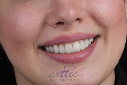 بازسازی لبخند با لمینت های سرامیکی - 10 واحد لمینت سرامیکی با حداقل تراش و حداقل ضخامت برای دندان های قدامی فک بالا