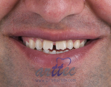 بازسازی لبخند با ۶ واحد لمینت سرامیکی برای فک بالا به منظور بهبود زیبایی لبخند و بستن فواصل بین دندانی، قبل از شروع طرح درمان زیبایی مراجعه کننده ابتدا انحراف فکی و ناهنجاری اکلوژن موجود در صورت برطرف شد