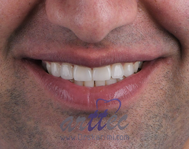 بازسازی لبخند با ۶ واحد لمینت سرامیکی برای فک بالا به منظور بهبود زیبایی لبخند و بستن فواصل بین دندانی، قبل از شروع طرح درمان زیبایی مراجعه کننده ابتدا انحراف فکی و ناهنجاری اکلوژن موجود در صورت برطرف شد