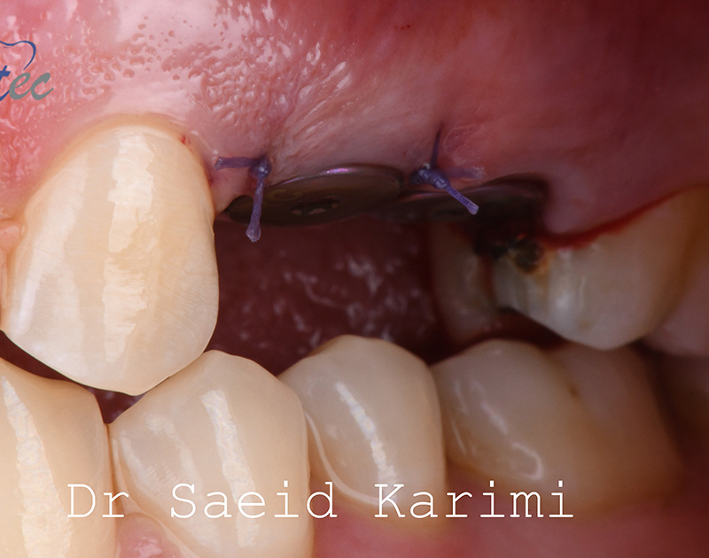 روش کاشت دندان در جردن
